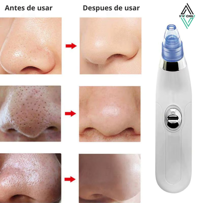 AcneFix™ REMOVEDOR ELECTRICO DE ACNE